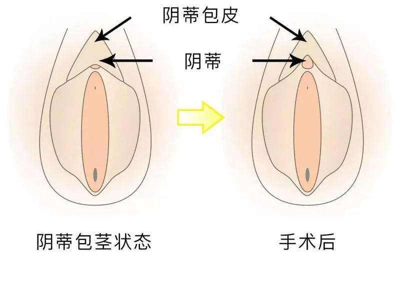 男性生殖器上长痘痘是什么原因？