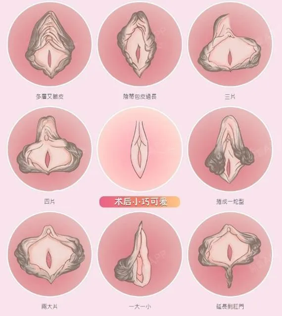 男性与女性鼻整形差异解析