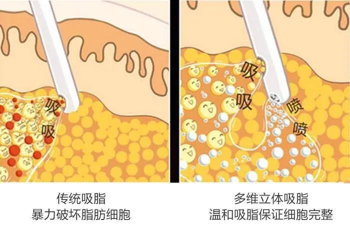 吸脂后脸会肿成“猪头”吗？对于恢复过程，阅读这篇文章就足够了。